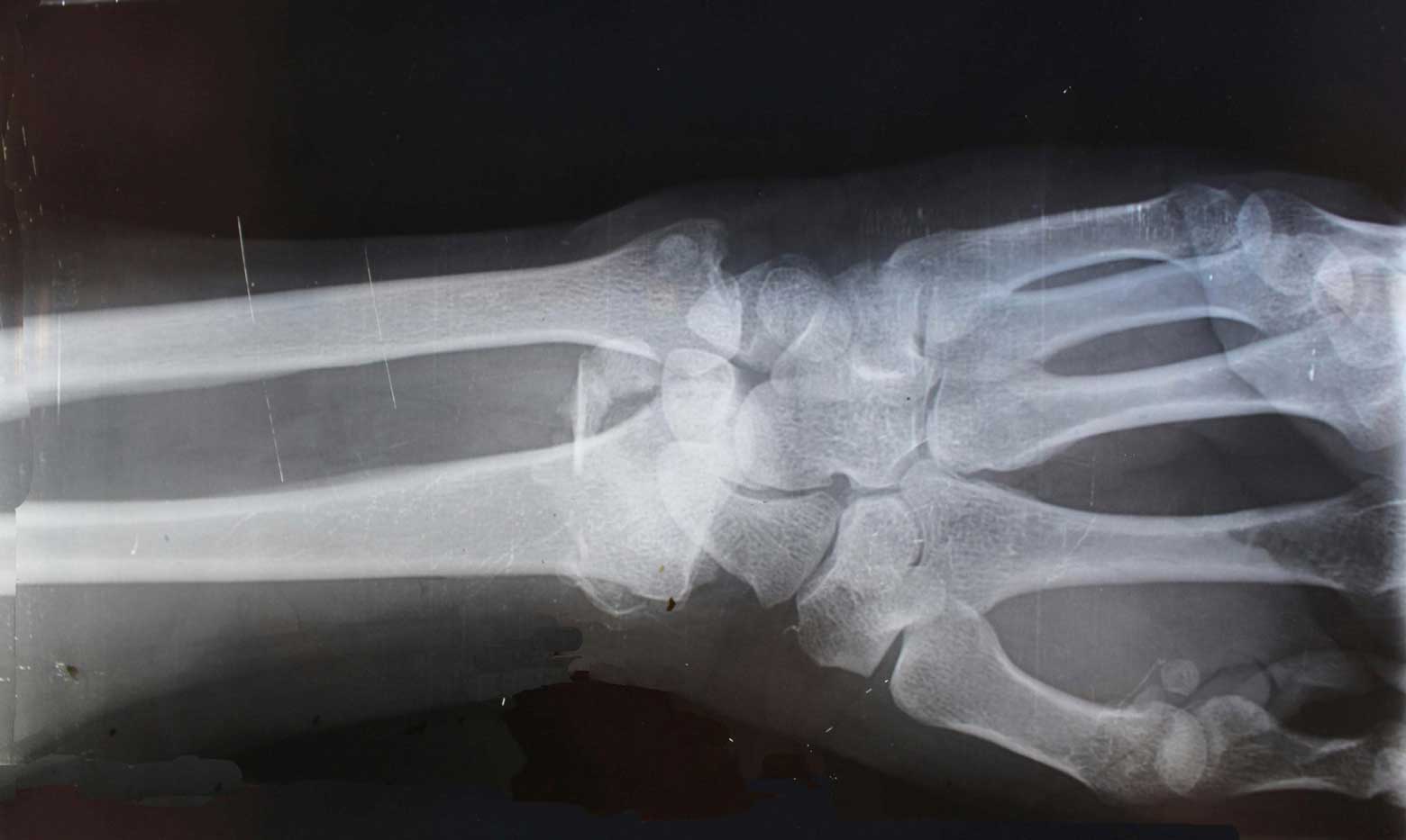 Catastrophic Injuries