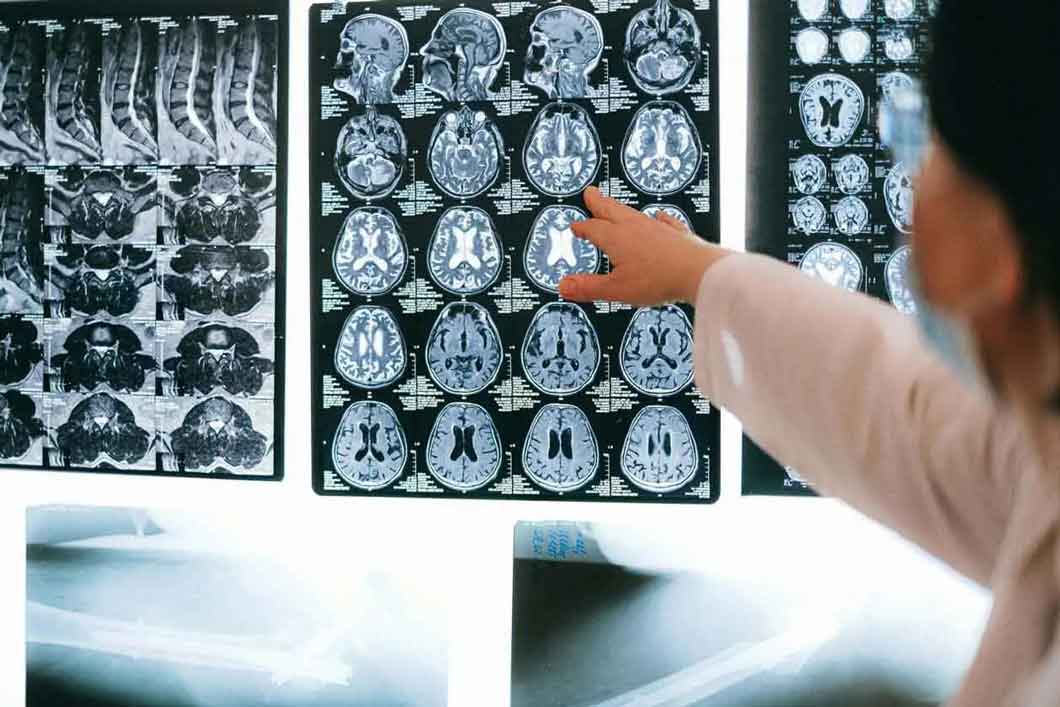 Brain Injuries